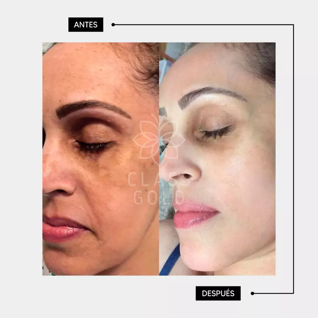 Despigmentante Facial 25 ML | Class Gold