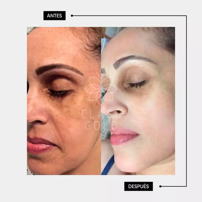 Despigmentante Facial 25 ML | Class Gold